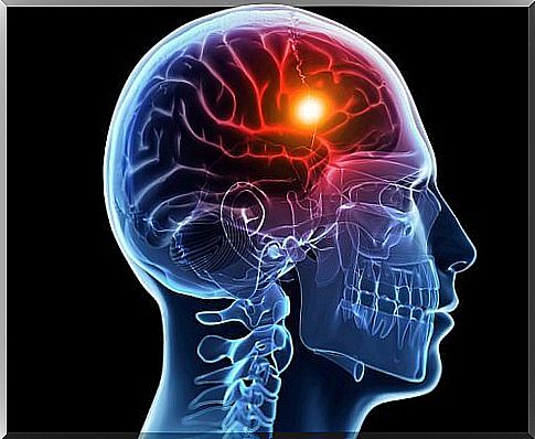 Stroke: causes and types